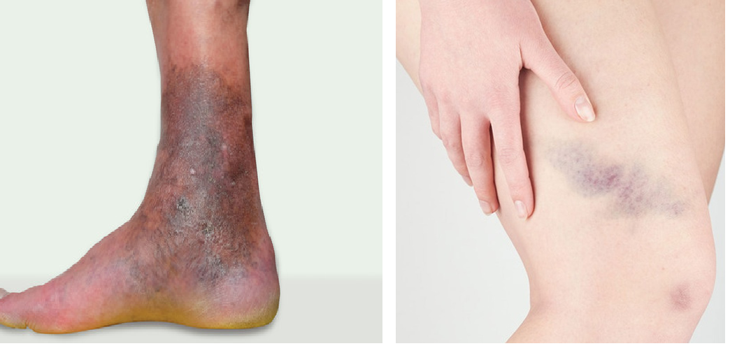 Thay đổi màu sắc da do suy giãn tĩnh mạch (trái) và hiện tượng bầm tím do va chạm (phải)