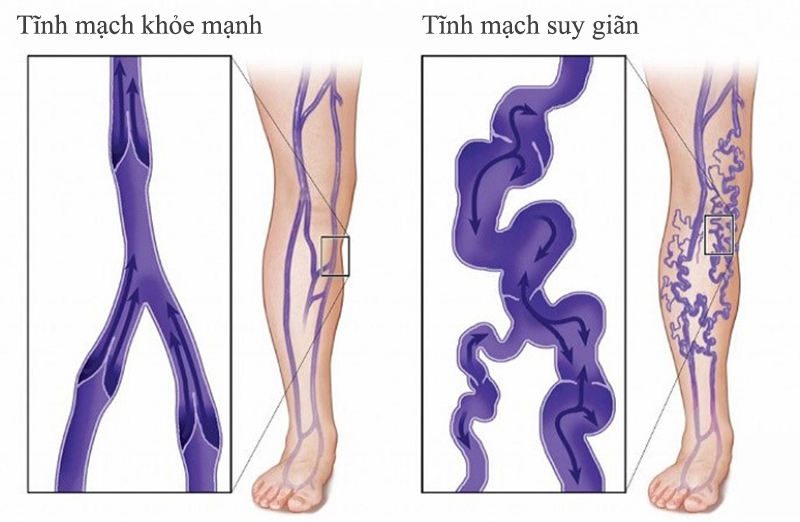Suy giãn tĩnh mạch chân là nguyên nhân hàng đầu gây hiện tượng vết bầm tím ở chân