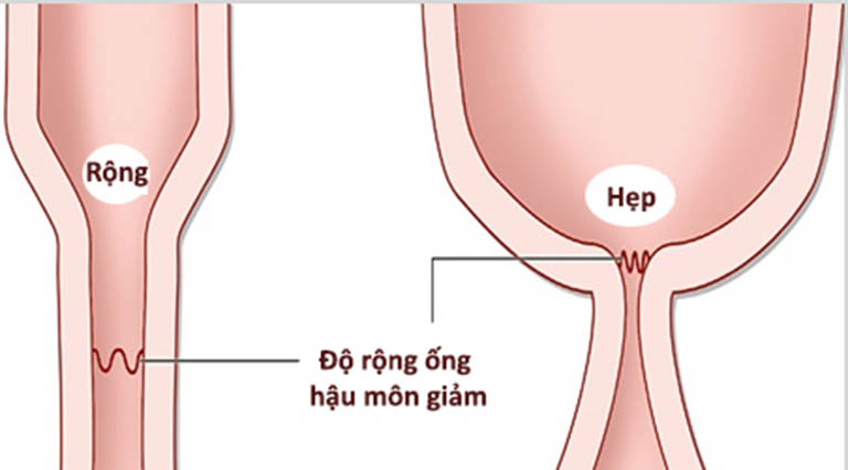 Hẹp hậu môn là biến chứng thường gặp sau phẫu thuật cắt trĩ