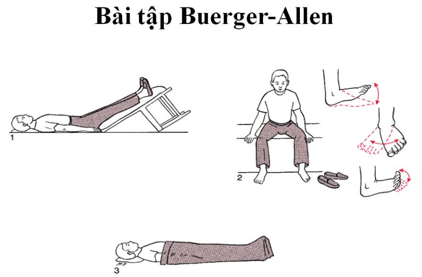 Cách thực hiện bài tập Buerger Allen