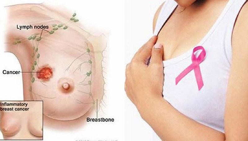 Kết quả hình ảnh cho ung thư vú ở phụ nữ mãn kinh